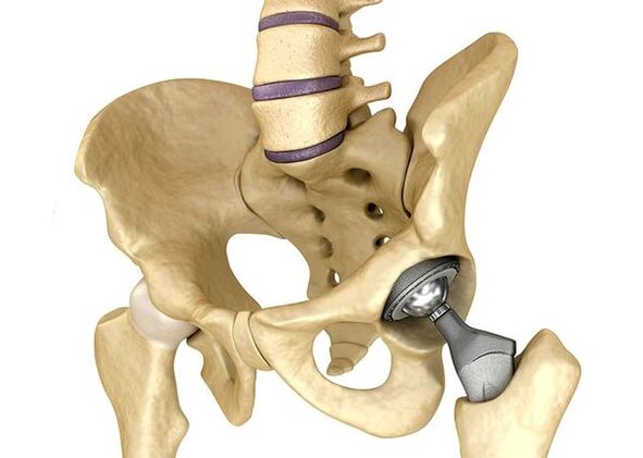 Endoprosthetik des Hüftgelenks