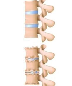 Die Ursachen der Osteochondrose