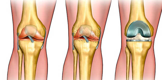 Im dritten Stadium der Arthrose ist ein Kniegelenkersatz erforderlich