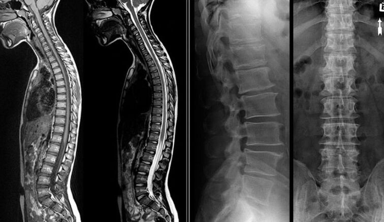 Röntgen- und MRT-Bilder bei Osteochondrose