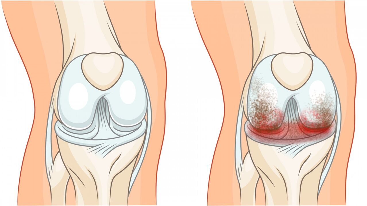 gesundes Gelenk und Arthrose des Kniegelenks