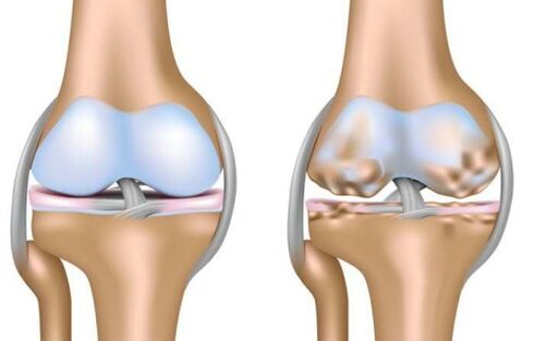 gesundes Gelenk und Zerstörung des Kniegelenks bei Arthrose