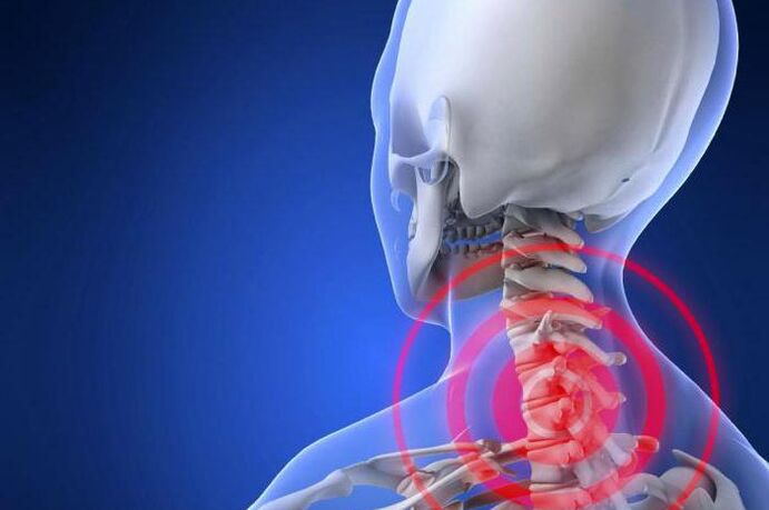 Stechende Schmerzen im Nacken - ein frühes Symptom der zervikalen Osteochondrose