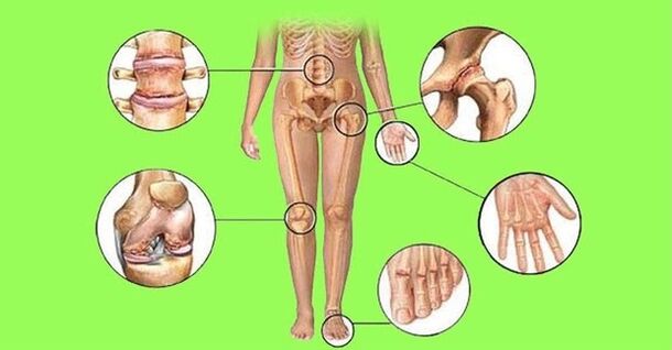 von Arthritis und Arthrose betroffene Gelenke