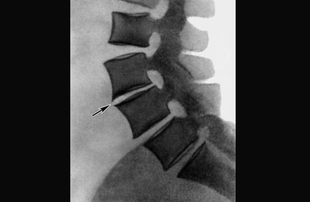 Manifestationen der Osteochondrose der Brustwirbelsäule im Röntgenbild