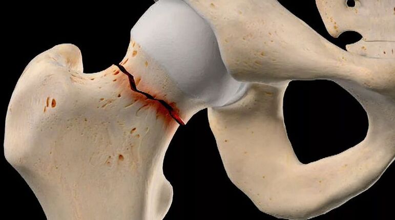 Der Schenkelhalsbruch ist eine der Ursachen der sekundären Coxarthrose. 