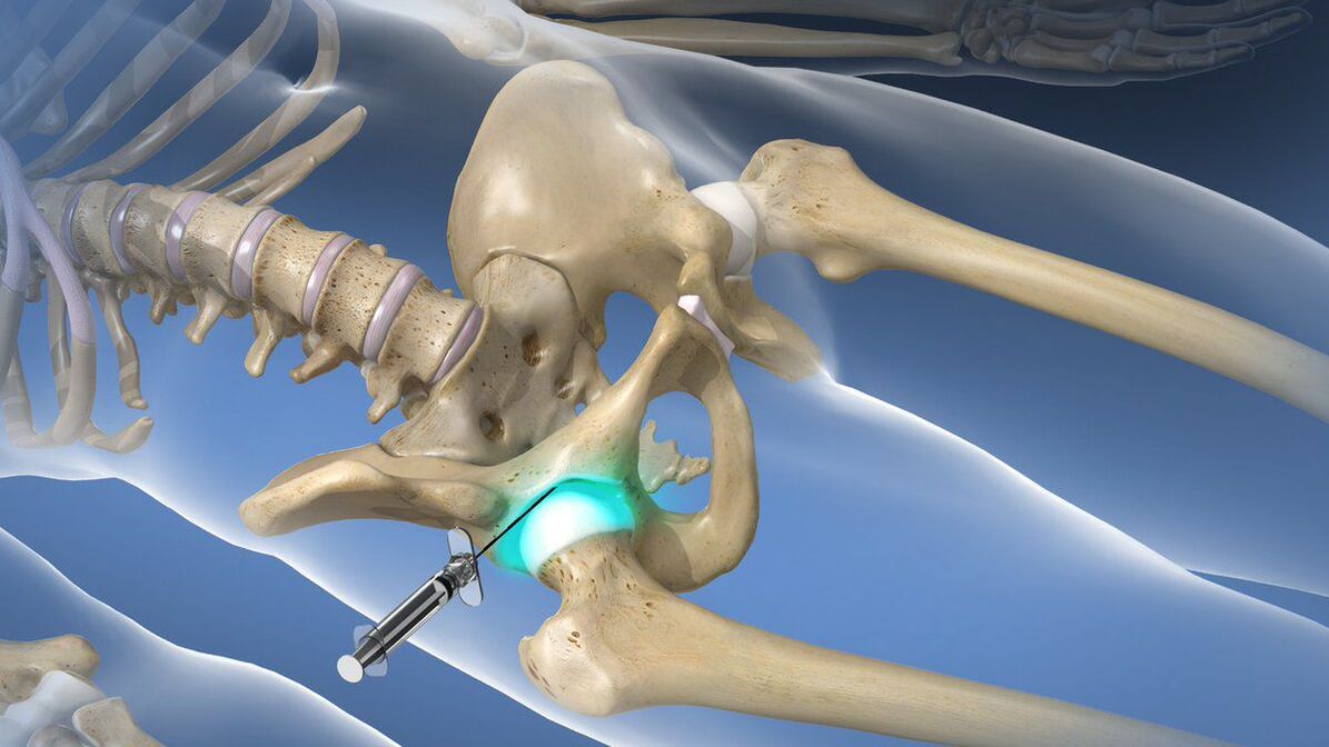 Intraartikuläre Blockade zur Beseitigung akuter Schmerzen bei Coxarthrose