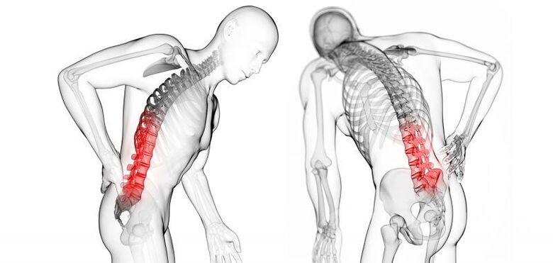 Komplikationen bei zervikaler Osteochondrose