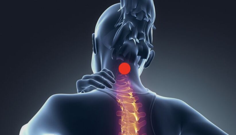 Symptome einer zervikalen Osteochondrose